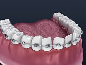 dental orthodontic braces 3D model