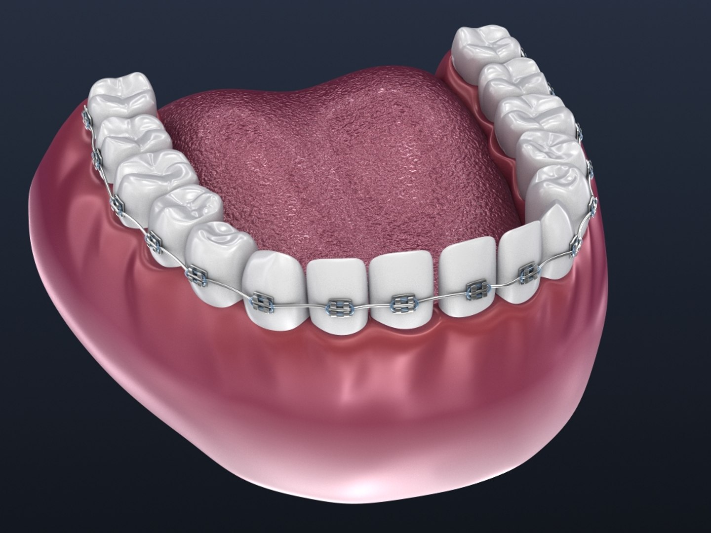 Dental orthodontic braces 3D model - TurboSquid 1340515