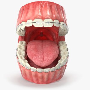 Human Mouth With Self Ligating Transparent Dental Braces V03