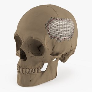 3D Titanium Cranioplasty Mesh Implant in Skull
