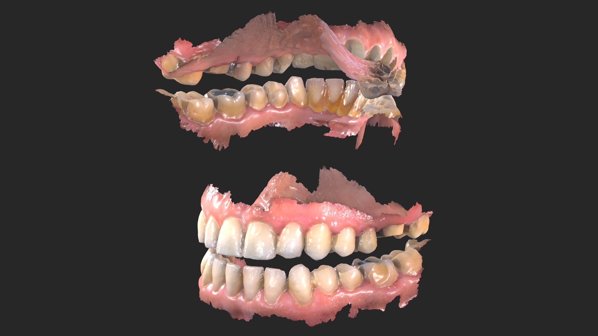 3D Dental Anatomy 3 Real Medical Cases Upper And Lower Jaw 3D Print ...