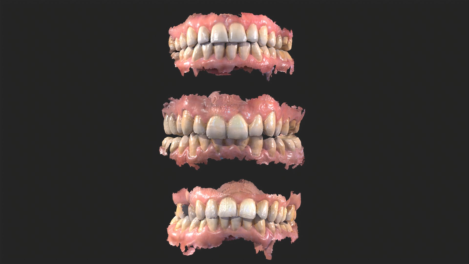 3D Dental Anatomy 3 Real Medical Cases Upper And Lower Jaw 3D Print ...