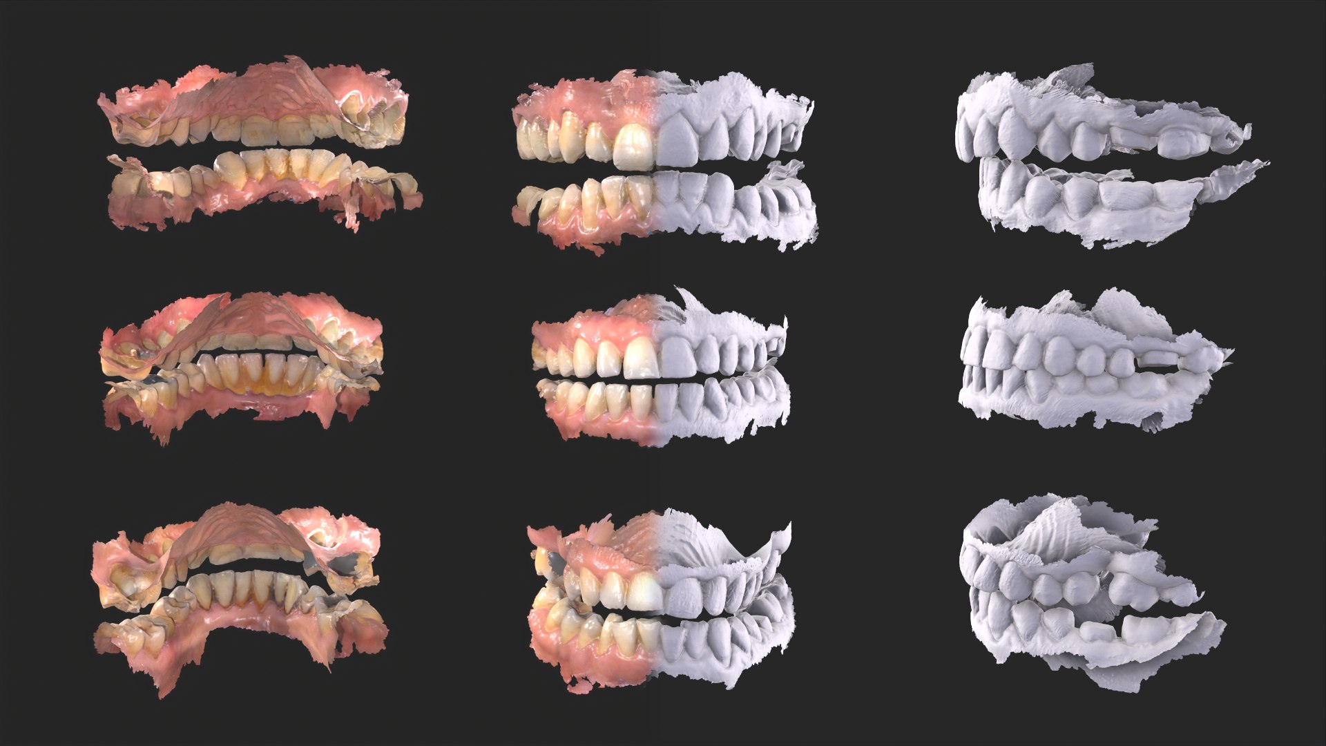 3D Dental Anatomy 3 Real Medical Cases Upper And Lower Jaw 3D Print ...