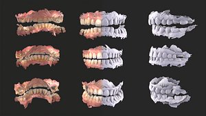3D Dental Anatomy 3 Real Medical Cases Upper and Lower Jaw 3D print model