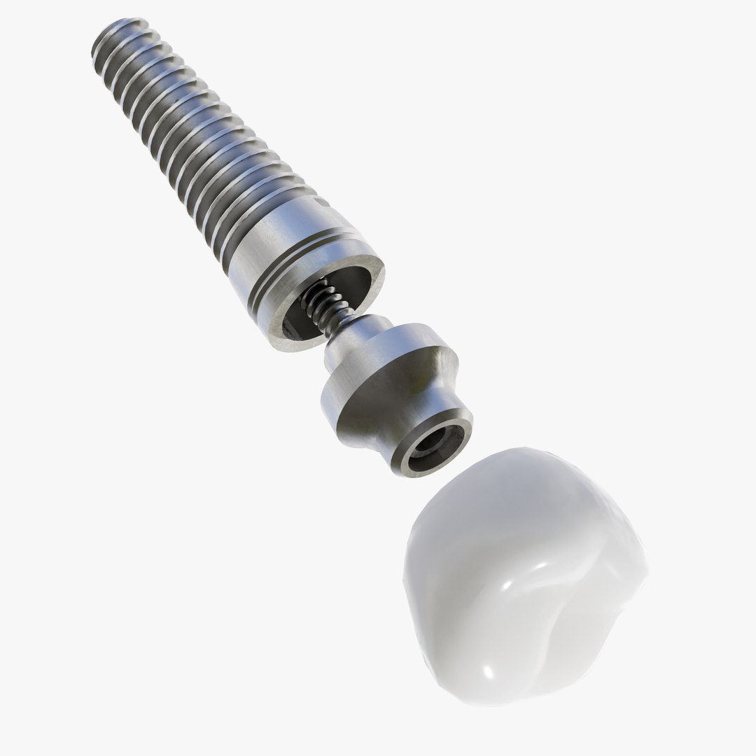 3D Dental Implant TurboSquid 1826444