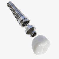 Dental Implant