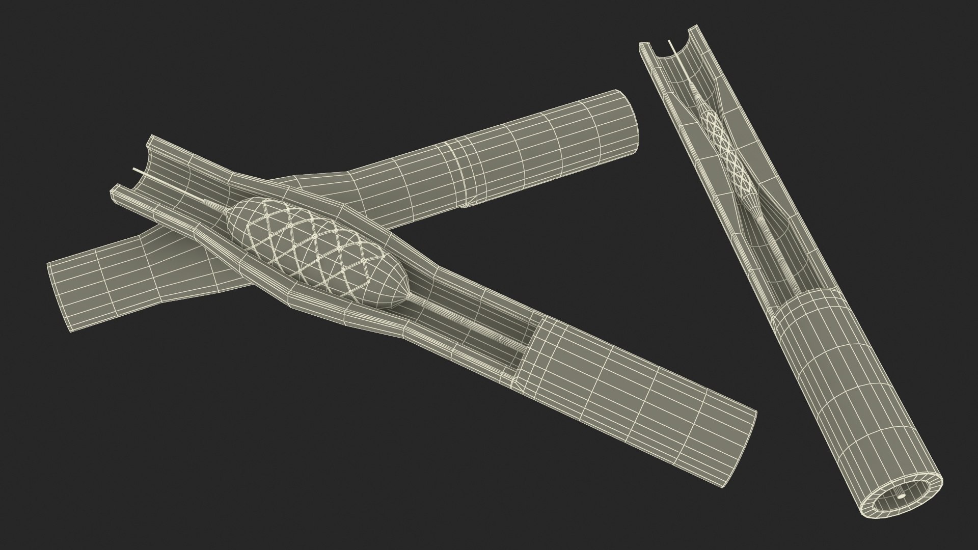 Stents with Artery 3D model https://p.turbosquid.com/ts-thumb/yY/zWgJhC/Ep/stentswitharteryvray3dmodel030/jpg/1717837275/1920x1080/fit_q87/c024854b2f0c1f2984e04b96da6a35a61d4f0f7d/stentswitharteryvray3dmodel030.jpg