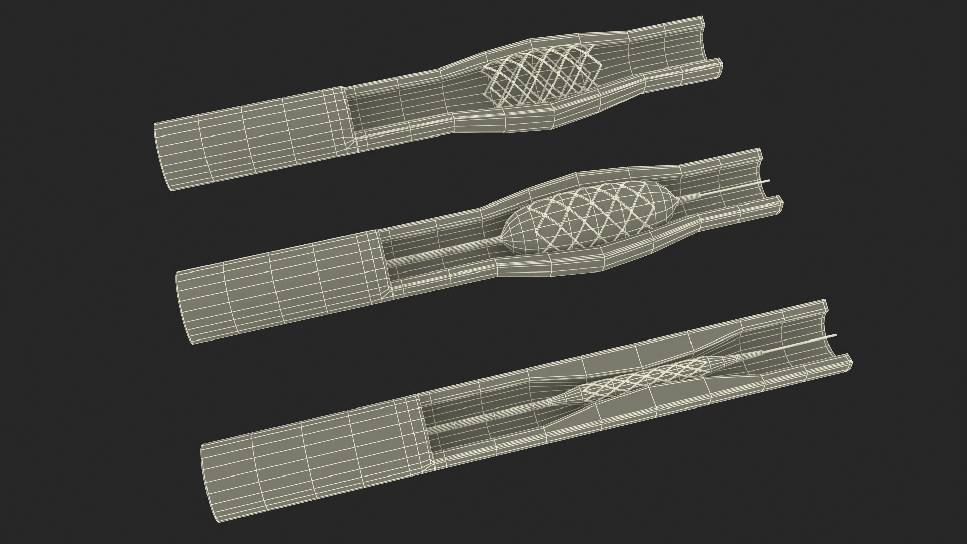 Stents with Artery 3D model https://p.turbosquid.com/ts-thumb/yY/zWgJhC/ML/stentswitharteryvray3dmodel028/jpg/1717837269/1920x1080/fit_q87/f116def486739f83d687f1805019b9b775e28a6b/stentswitharteryvray3dmodel028.jpg