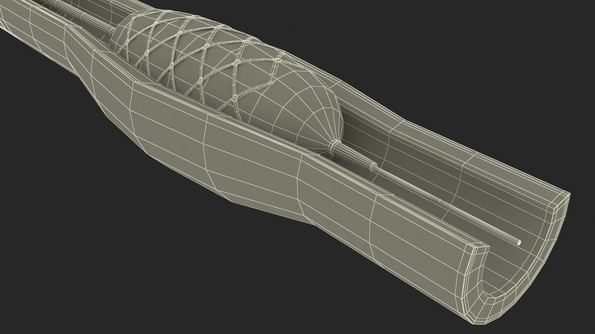 Stents with Artery 3D model https://p.turbosquid.com/ts-thumb/yY/zWgJhC/S4/stentswitharteryvray3dmodel035/jpg/1717837290/1920x1080/fit_q87/1aaff86820a3ad382d1a2474e29d690ea0d0026d/stentswitharteryvray3dmodel035.jpg