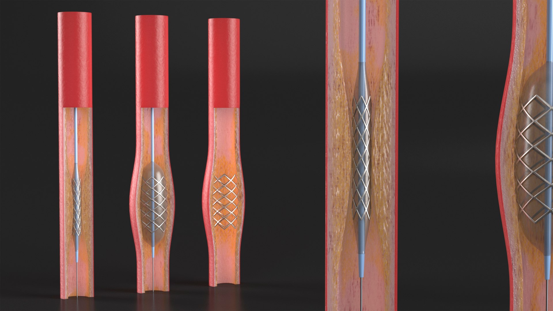 Stents with Artery 3D model https://p.turbosquid.com/ts-thumb/yY/zWgJhC/hB/stentswitharteryvray3dmodel007/jpg/1717837203/1920x1080/fit_q87/0acf6ab3d1cc96ed2ce6977e89eaede4a1b65d04/stentswitharteryvray3dmodel007.jpg