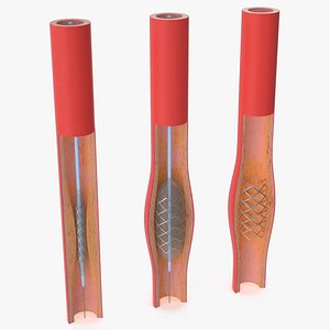 Stents with Artery 3D model