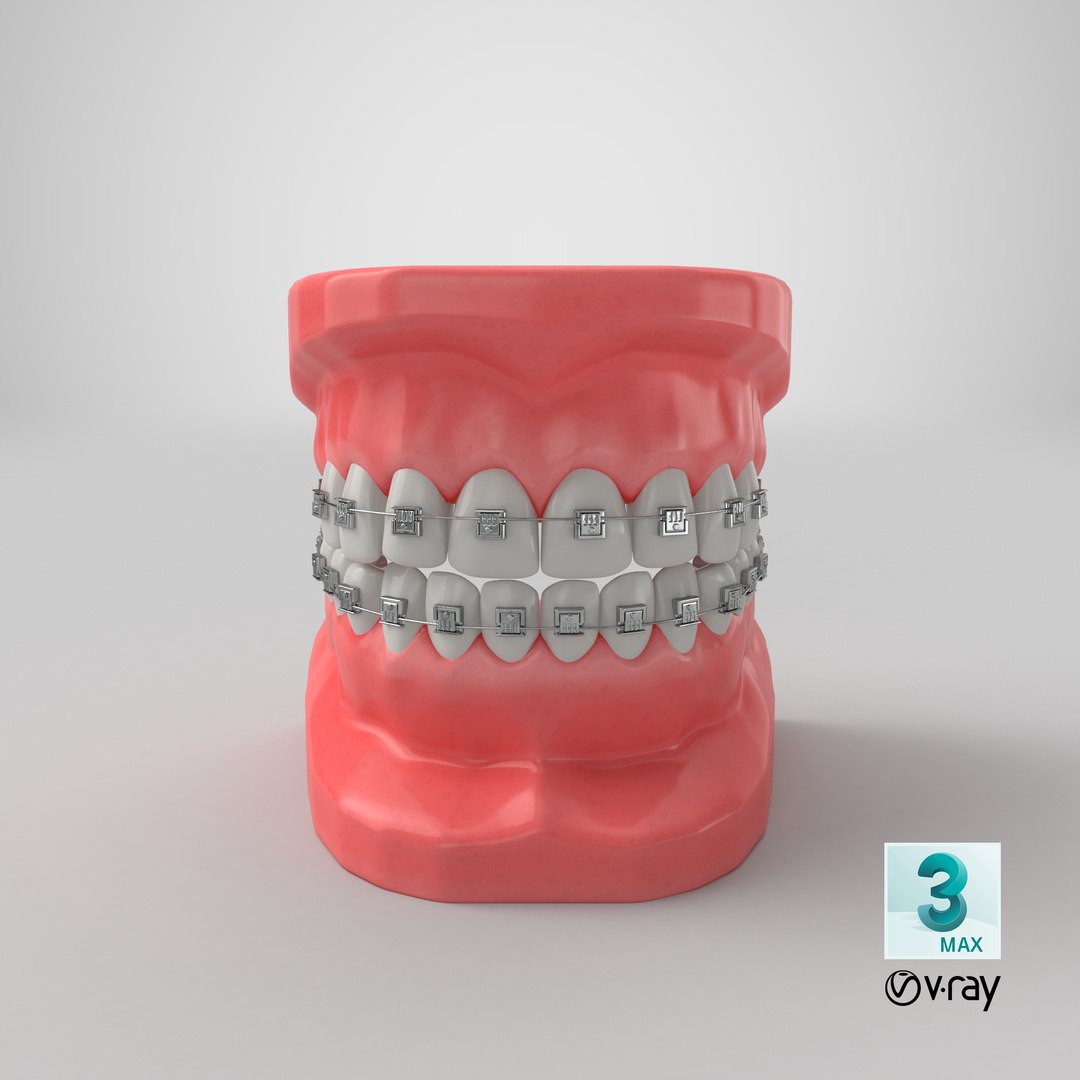 3D mouth braces modeled model https://p.turbosquid.com/ts-thumb/yn/mCjnvL/7NwFaaEj/render.0001/png/1518036874/1920x1080/fit_q87/2c65ed5d7c8104bb2b0d7f0f408690979dc3cb3e/render.0001.jpg