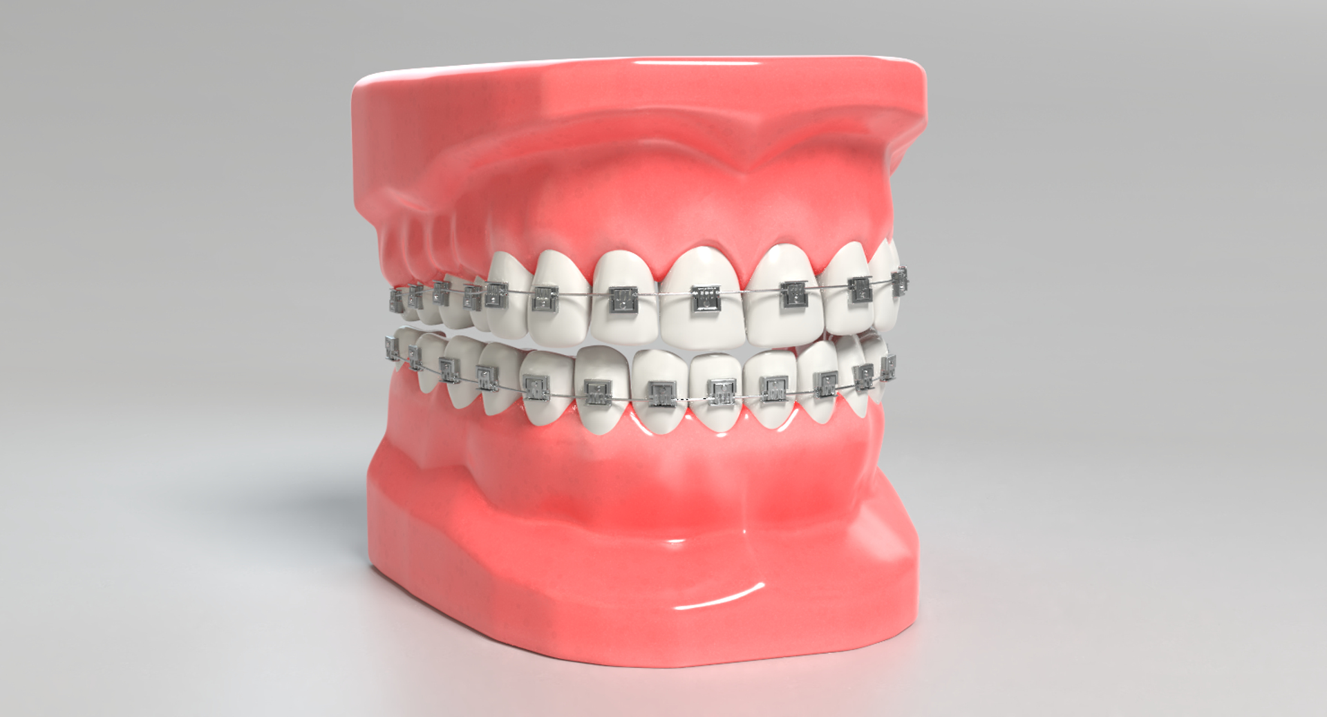 3D mouth braces modeled model https://p.turbosquid.com/ts-thumb/yn/mCjnvL/7iFm8fhL/images/png/1517861441/1920x1080/turn_fit_q99/7bdbe83bc5e306eff1e1f66d21c7a7722cc2007a/images-1.jpg