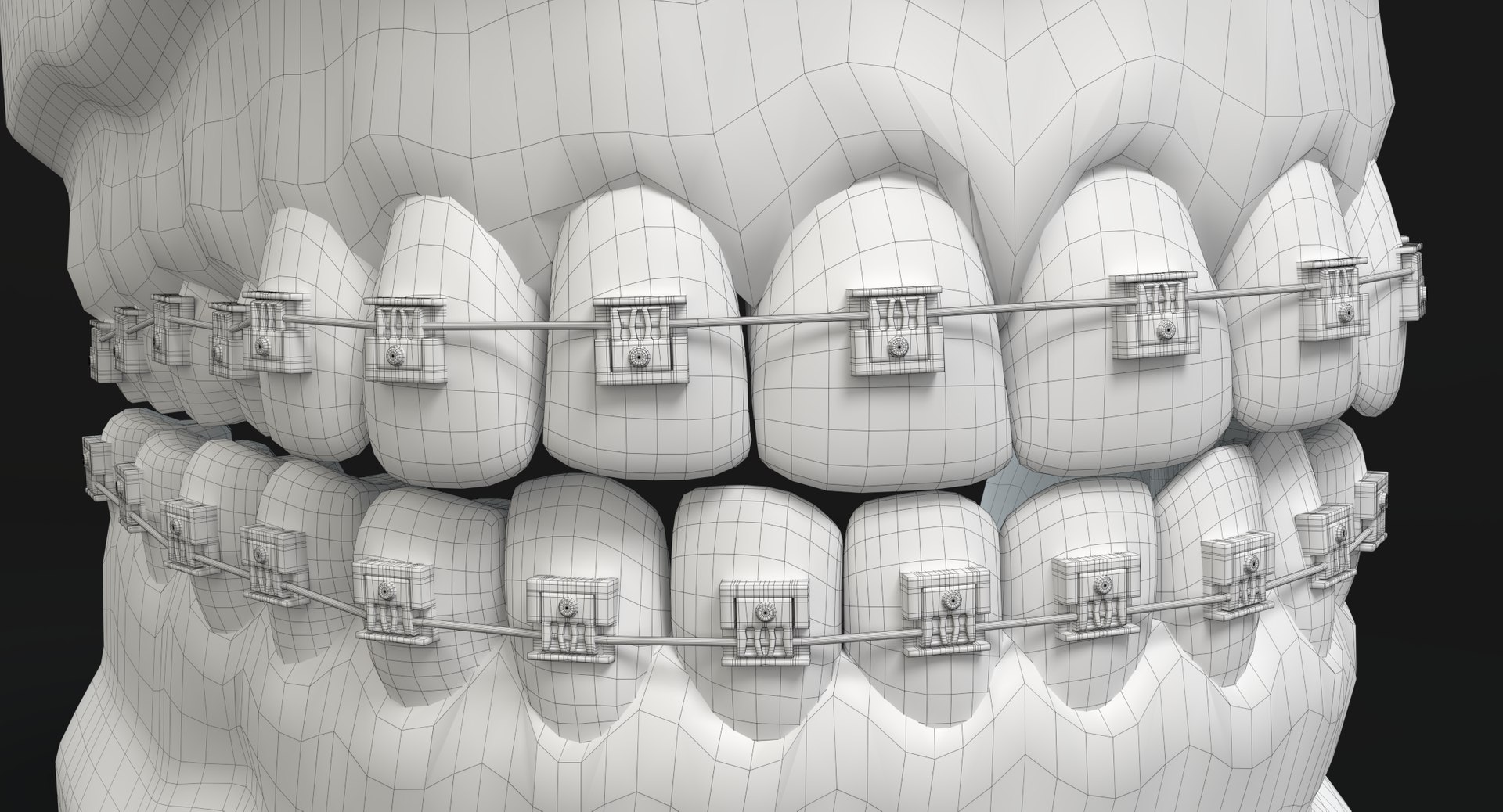 3D mouth braces modeled model https://p.turbosquid.com/ts-thumb/yn/mCjnvL/7k47QNsc/wireframe_2/png/1517861422/1920x1080/fit_q87/427640430a5f9debed4875283fa1dae52a4b3840/wireframe_2.jpg