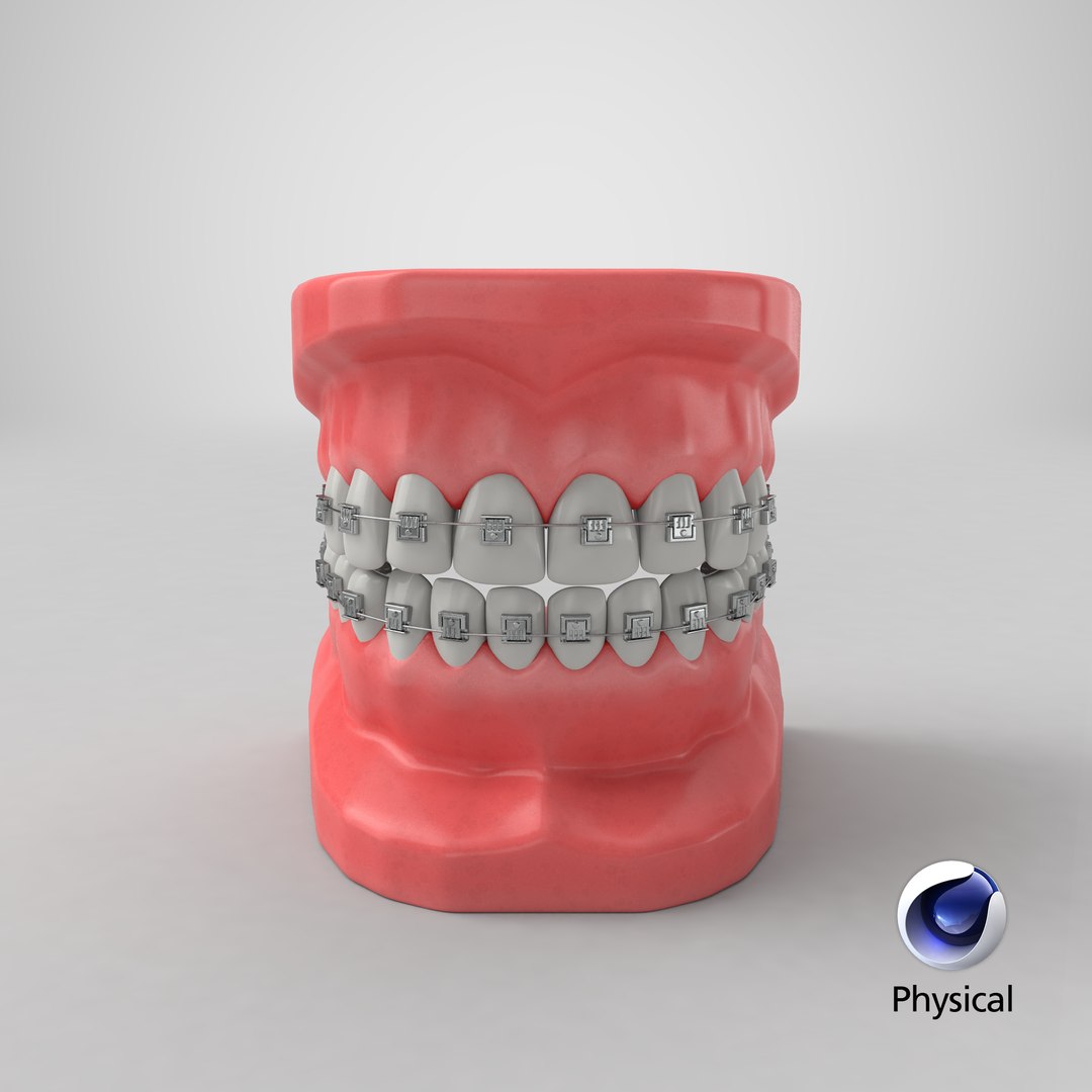 3D mouth braces modeled model https://p.turbosquid.com/ts-thumb/yn/mCjnvL/ASFqlUlQ/render.0001/png/1518036885/1920x1080/fit_q87/51faa83a42339a6581b778ff93b34e4ab70bb0e6/render.0001.jpg