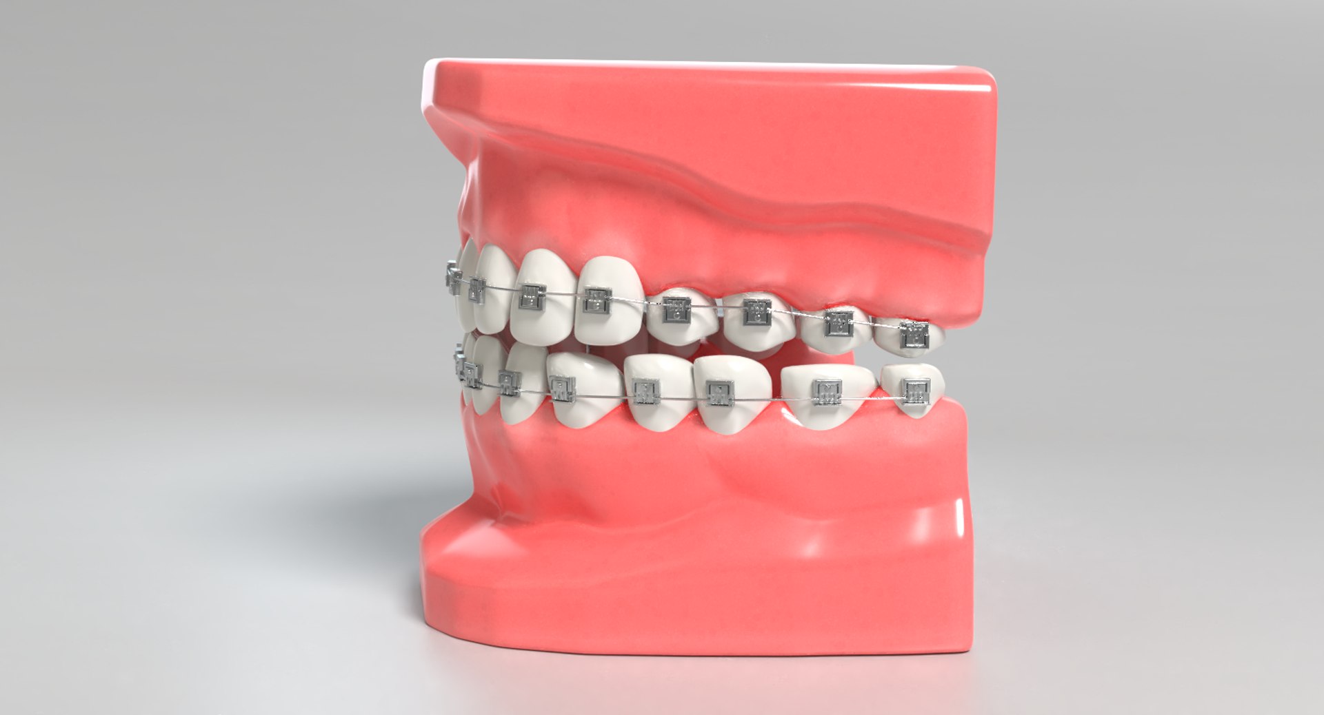 3D mouth braces modeled model https://p.turbosquid.com/ts-thumb/yn/mCjnvL/KvbASBxg/images0027/png/1517861415/1920x1080/fit_q87/13cfe0a555efc43ea947ca426f0fce5da954e284/images0027.jpg