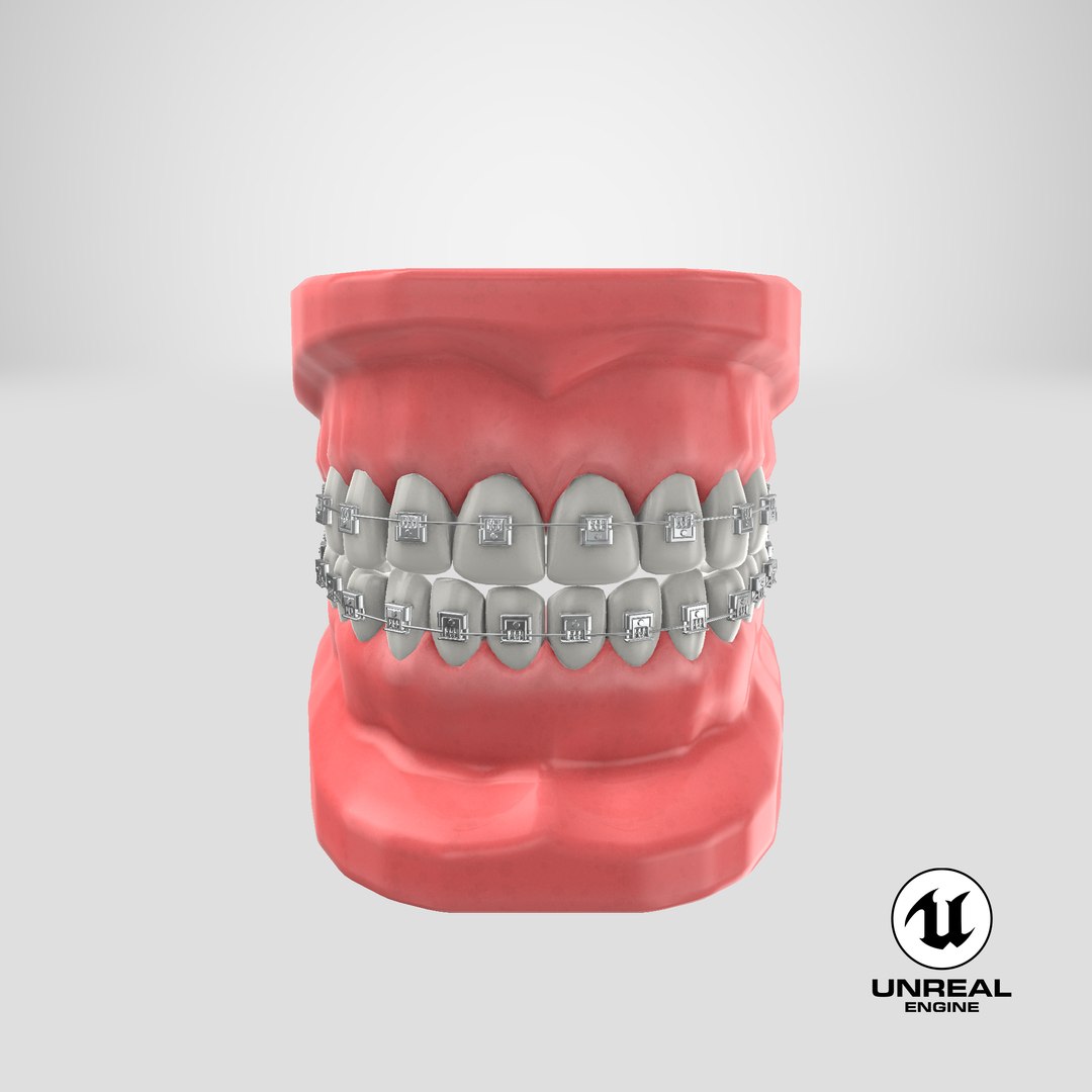 3D mouth braces modeled model https://p.turbosquid.com/ts-thumb/yn/mCjnvL/LOjlLl8P/unreal_capture/png/1518036889/1920x1080/fit_q87/b58f346be380f6ddda1715a99d2af28f7b5a226a/unreal_capture.jpg
