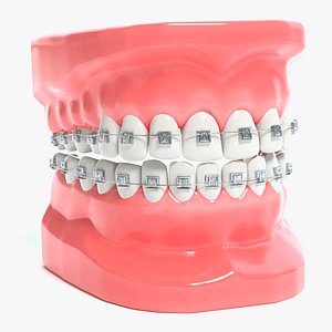 Braces Model
