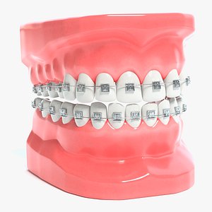 Braces Model