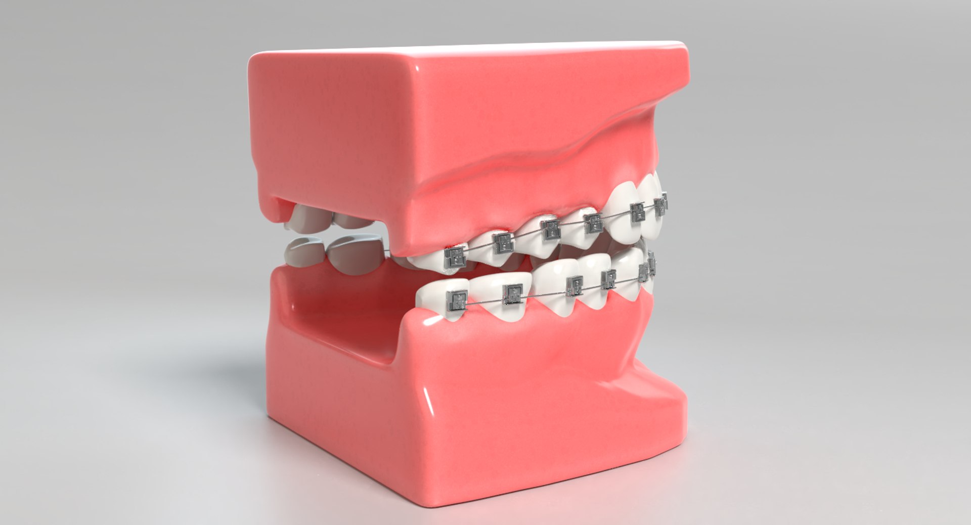 3D mouth braces modeled model https://p.turbosquid.com/ts-thumb/yn/mCjnvL/e7iyuvz1/images0011/png/1517861415/1920x1080/fit_q87/be779e4448a3330b842e7496ab28ed2c59ff871a/images0011.jpg