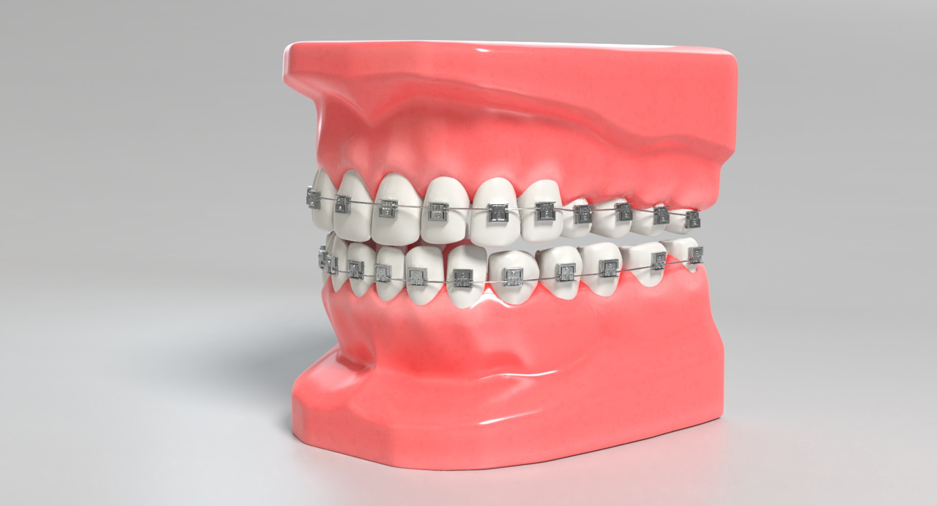 3D mouth braces modeled model https://p.turbosquid.com/ts-thumb/yn/mCjnvL/gimVJdlA/images0031/png/1517861415/1920x1080/fit_q87/707be17b5e4e0900249870ed64354472b6e15c67/images0031.jpg