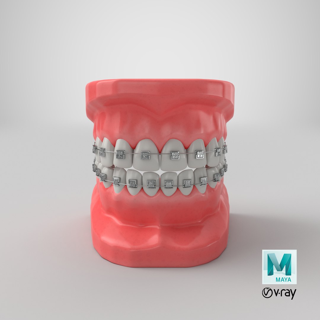 3D mouth braces modeled model https://p.turbosquid.com/ts-thumb/yn/mCjnvL/jm1duUS8/render.0001/png/1518036865/1920x1080/fit_q87/252ab23b098741953447096a953763851fc14dbf/render.0001.jpg