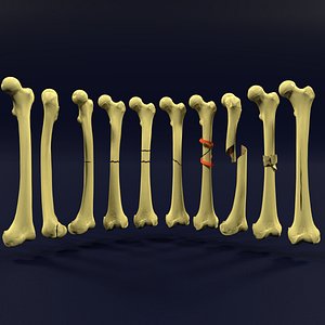 Fracture types labelled