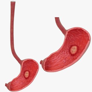 Stomach ulcers erosion of the stomach lining with animation Human organ