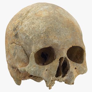 human skull cranium leprosy 3D model