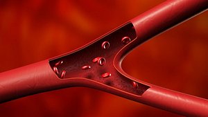 Artery Vein Clog Clot Clogged Stream Bloodflow Layers Section Anatomy