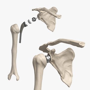 Shoulder Joint Implant with Humerus and Scapula