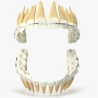 Human Teeth With Self Ligating Transparent Dental Braces V03