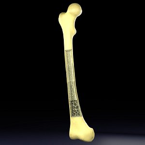 Osteoporosis and its stages 3D model