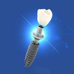 dental implant 3d max